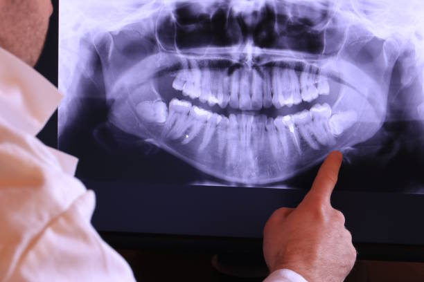 Best Emergency Treatment for Dental Infections or Abscesses in Merryville, LA